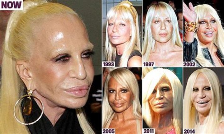 Donatella Versace before and after series of plastic surgery